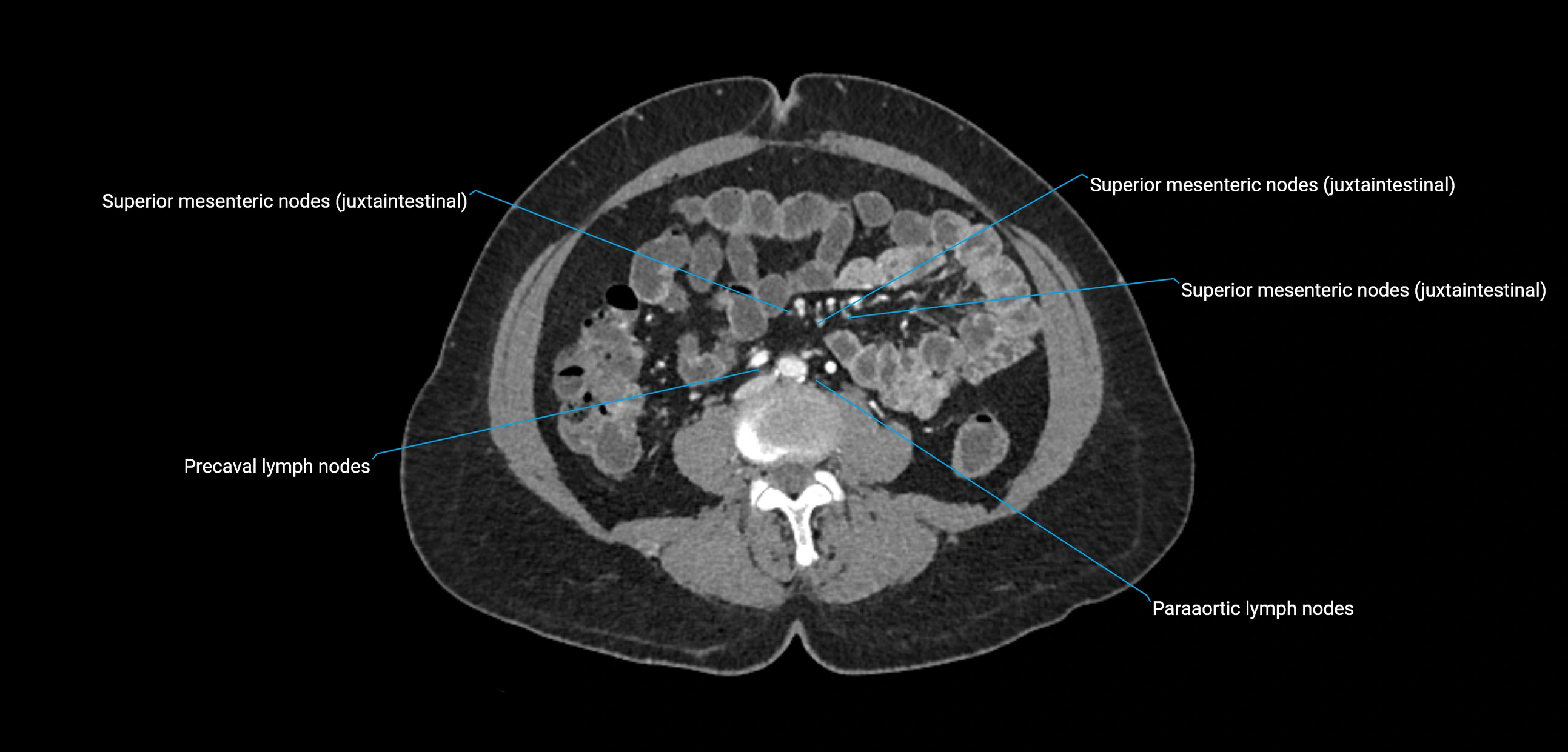 CT ct abdominal lymph nodes  axial cross sectional anatomy  enchanced radiology image -img-00002-00252.webp